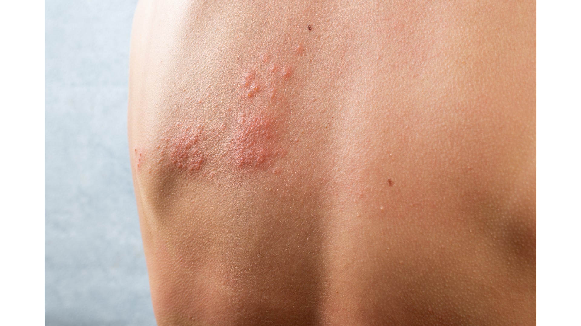 Close-up of a reddish skin rash on a person's back, representing rash, an early HIV symptom
