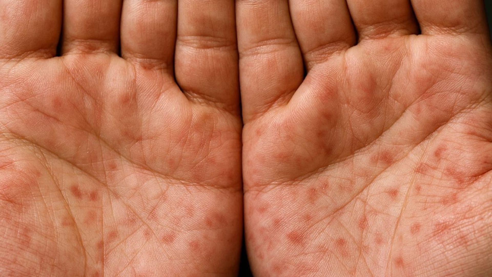 Close-up of two palms covered in small reddish-brown spots, a rash pattern that can occur with syphilis